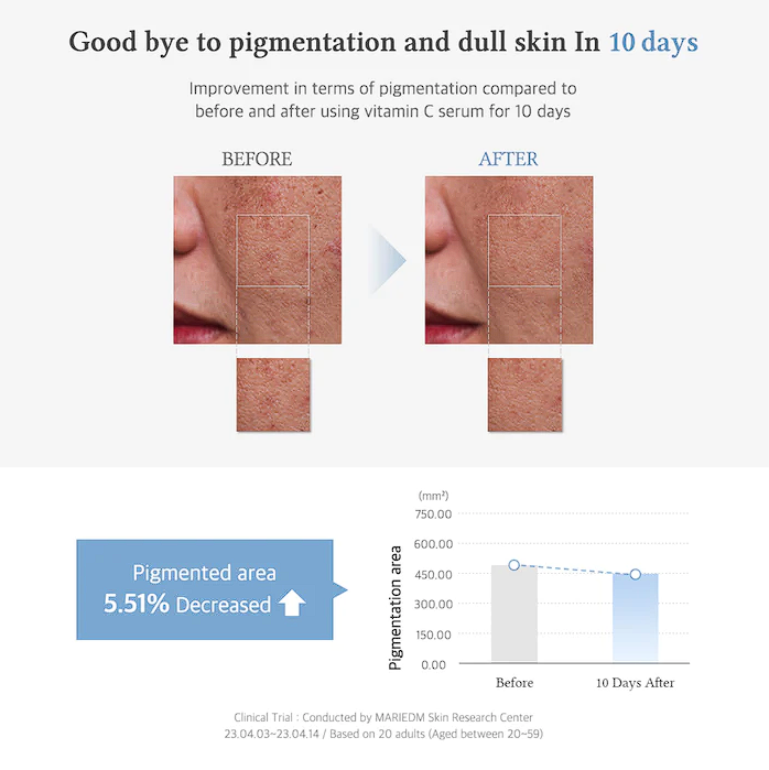 Good bye to pigmentation and dull skin in 10 days. Pigmented areas decreased by 5.51%